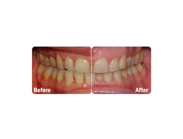 ProBiora Oral Probiotics for Teeth and Gums | Dental Probiotics for Improved Oral Health | Bad Breath Treatment for Adults | ProBiora3 Patented Probiotic Blend | Tooth Whitening | 30 Mint Tablets