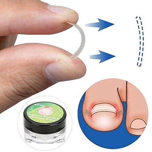 Professional Ingrown Pincer Toenail Correction Sticker Pedicure Paronychia Recover Foot CareTool with Nail File and Cuticle Pusher(12Pcs Patches)