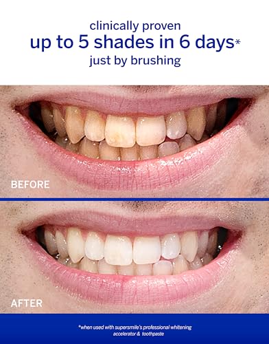 Professional Teeth Whitening System , 1 Count (Pack of 1)