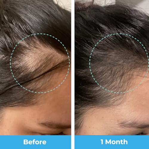 Postpartum Hair Loss Vitamins - Passion Fruit Gummies with Biotin, Collagen, & Folate