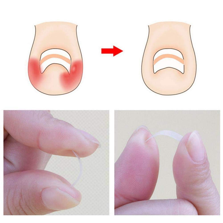 24 Pcs Stickers: Nail Fixer Pedicure Toenail, 6 In 1 Set Ingrown Toe Nail Corrector Tool Recover Correction Tool Nail Foot Care Kit(24 Pcs Stickers)
