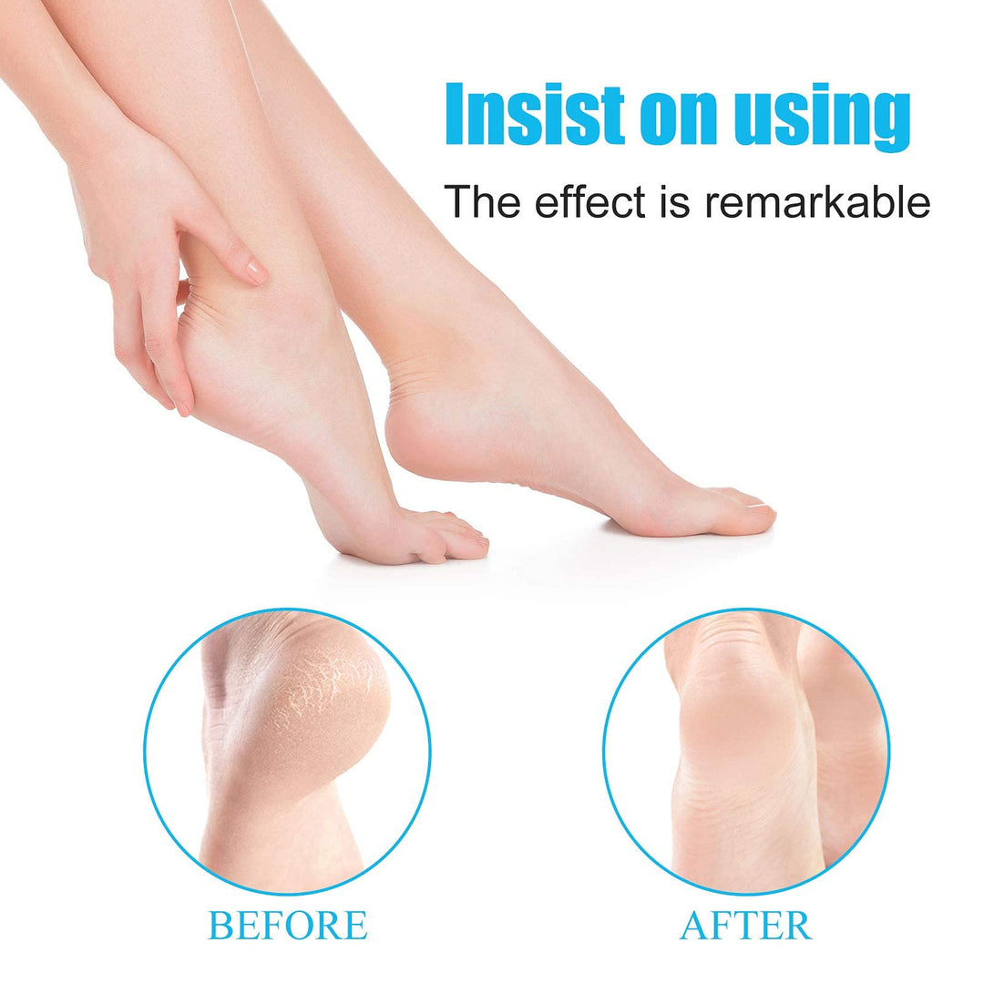 Foot Scrubber Callus Remover,Professional Pedicure Kit Heel Scraper for Feet Dead Skin Removal, Cracking, Hard Cracked Dry Skin Removal, Wet and Dry Feet.
