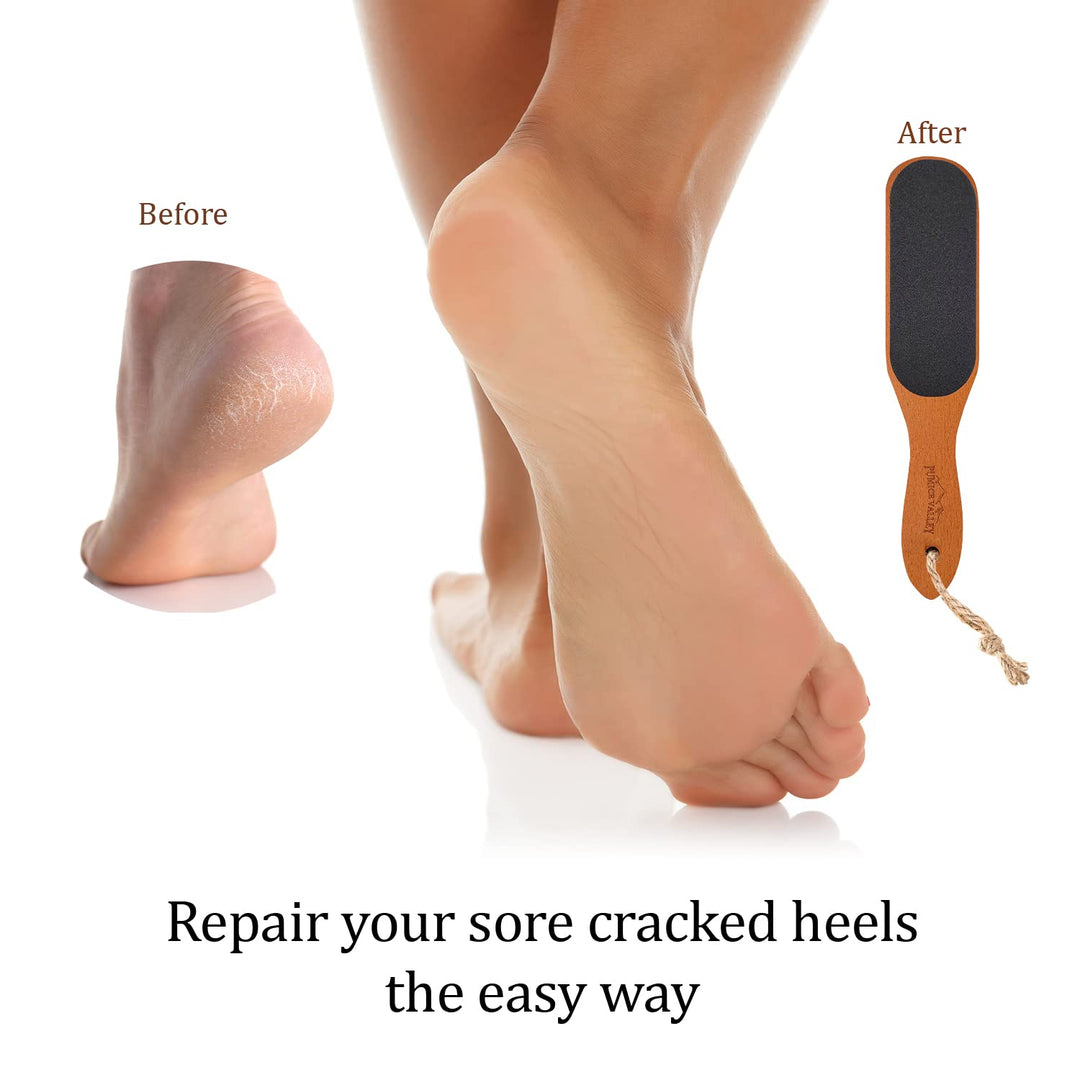 Pumice Stone Foot Scrubber - Pedicure Foot File with Handle for Dry Dead Skin - Callus Remover for Feet - Foot Scraper - Exfoliating Brush for Heels, Elbows, Hands