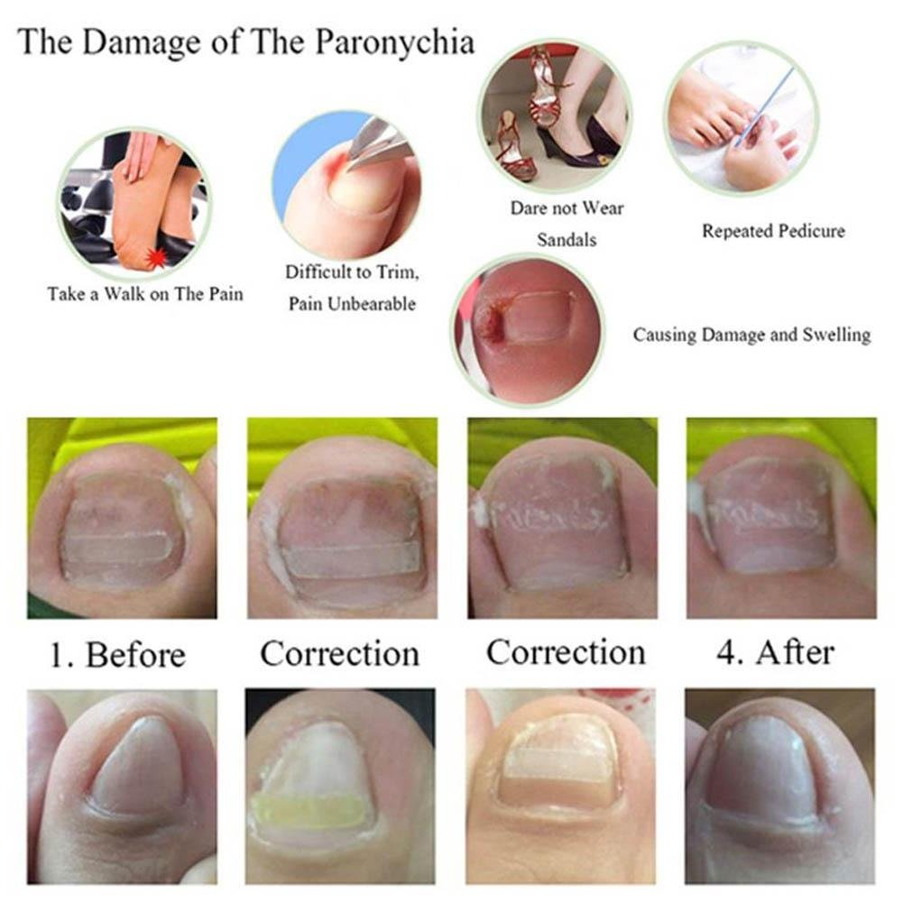 24 Pcs Stickers: Nail Fixer Pedicure Toenail, 6 In 1 Set Ingrown Toe Nail Corrector Tool Recover Correction Tool Nail Foot Care Kit(24 Pcs Stickers)