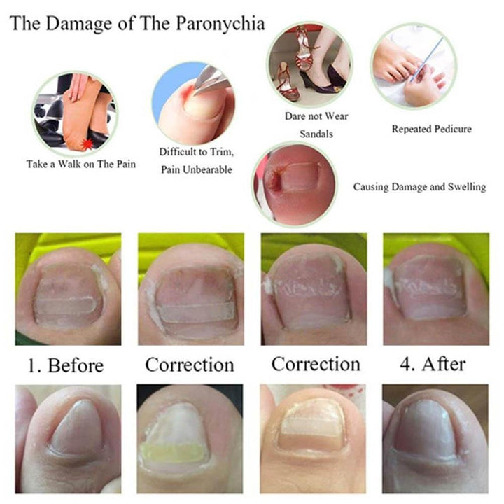 24 Pcs Stickers: Nail Fixer Pedicure Toenail, 6 In 1 Set Ingrown Toe Nail Corrector Tool Recover Correction Tool Nail Foot Care Kit(24 Pcs Stickers)