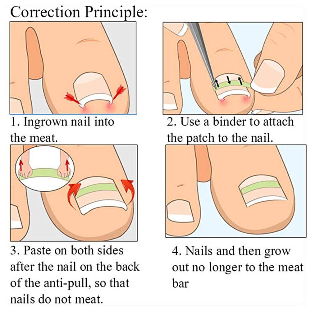 24 Pcs Stickers: Nail Fixer Pedicure Toenail, 6 In 1 Set Ingrown Toe Nail Corrector Tool Recover Correction Tool Nail Foot Care Kit(24 Pcs Stickers)