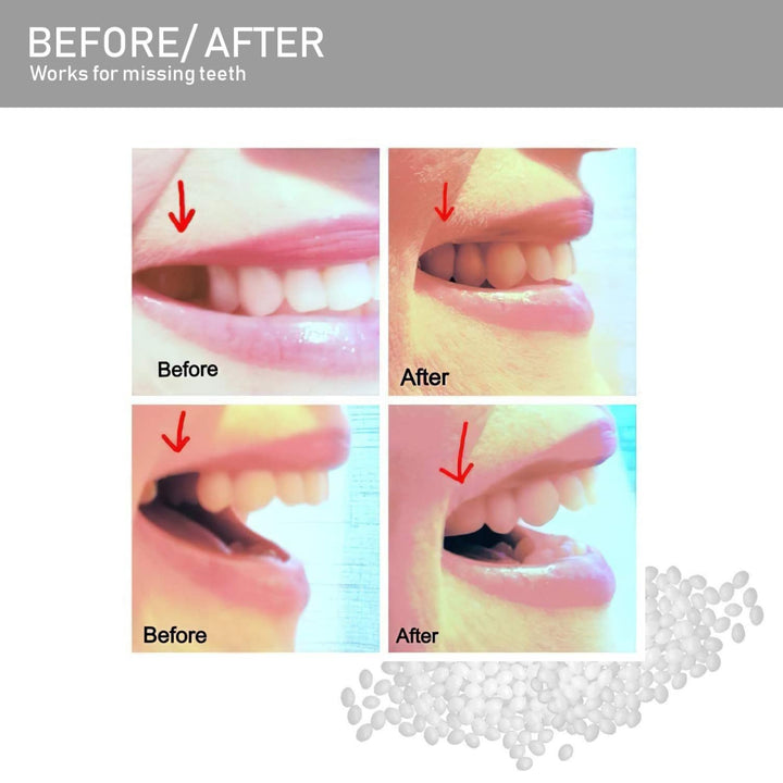 Teeth Repair Kit, Temporary Teeth Replacement Kit, Do it Yourself Thermal Fitting Beads, Moldable False Teeth for Snap On Instant and Confident Smile