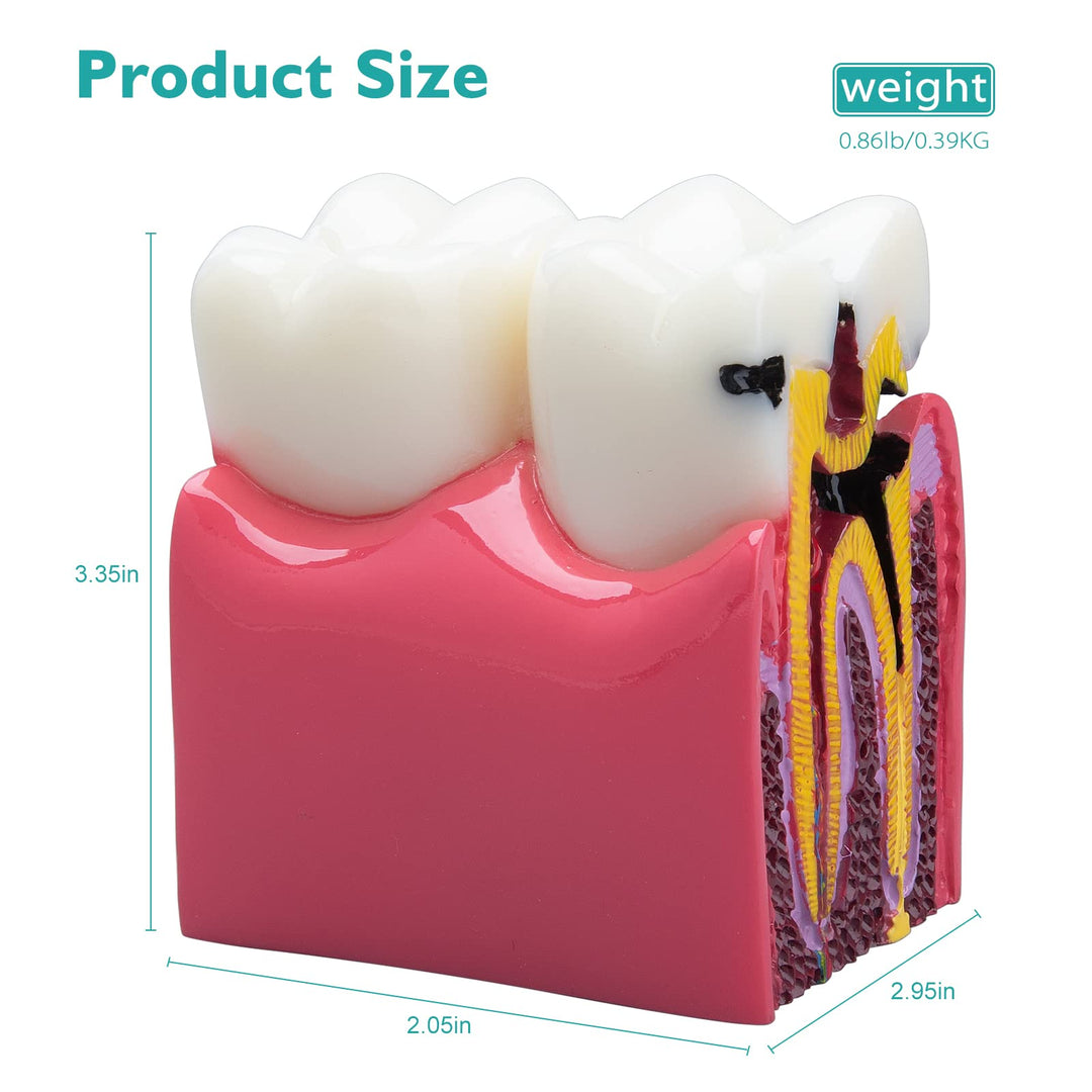 Dental Caries Teeth Model - Anatomy Education Model Caries Bilateral Comparison Study Model 6 Times Cross-Section Demonstration Model Tooth Decay Props for Science Teaching