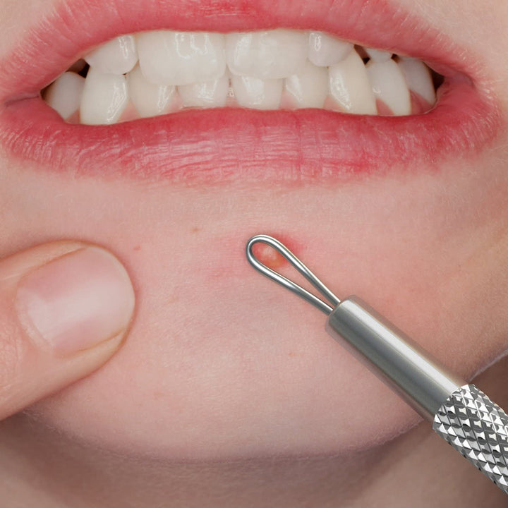 SC-1103-SSP Whitehead / Acne Remover & Comedone Extractor