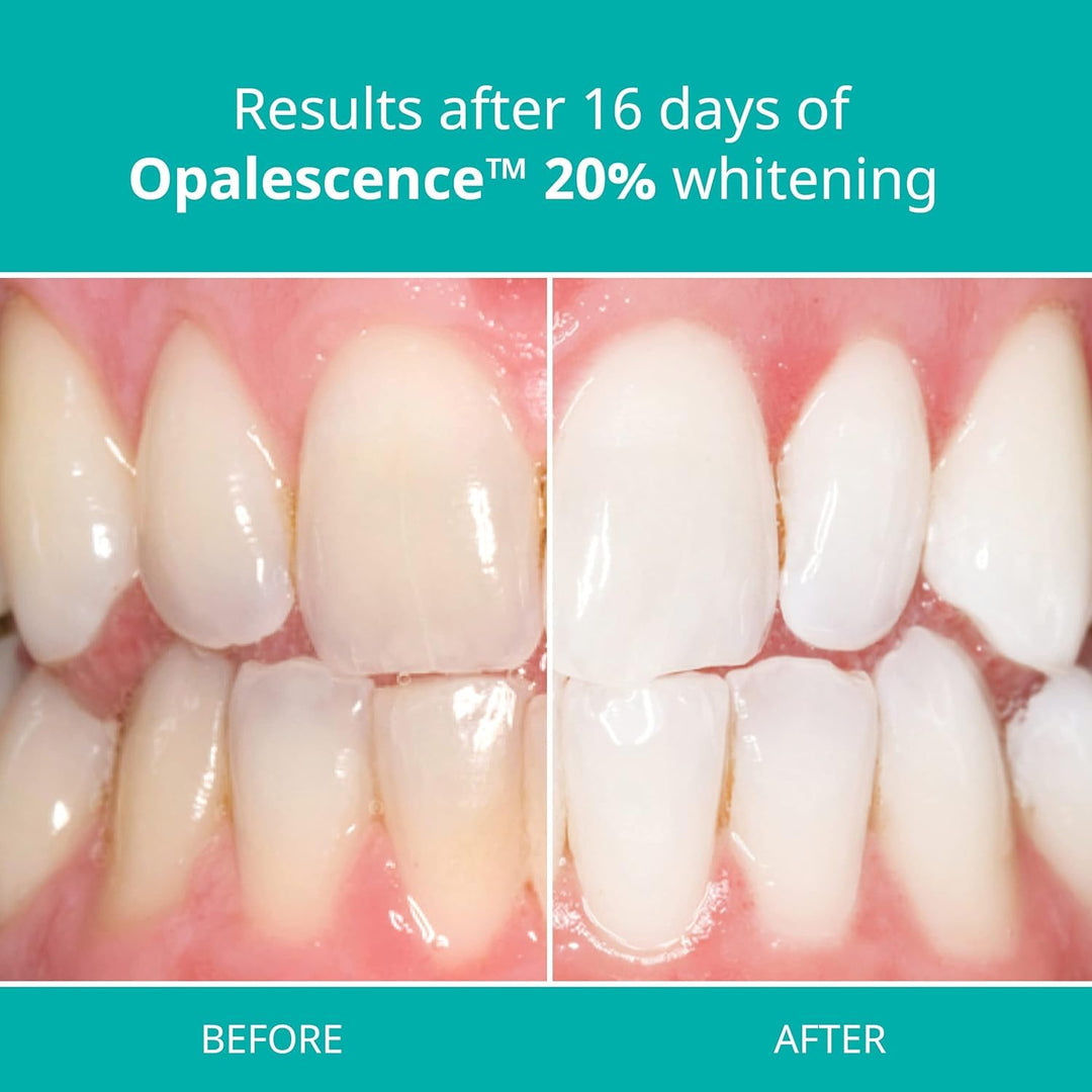 20% Teeth Whitening Refill Kit (2 Packs / 4 Syringes) Carbamide Peroxide. Made by Ultradent, in Mint Flavor. Tooth Whitening Refill Syringes - B-5196-4