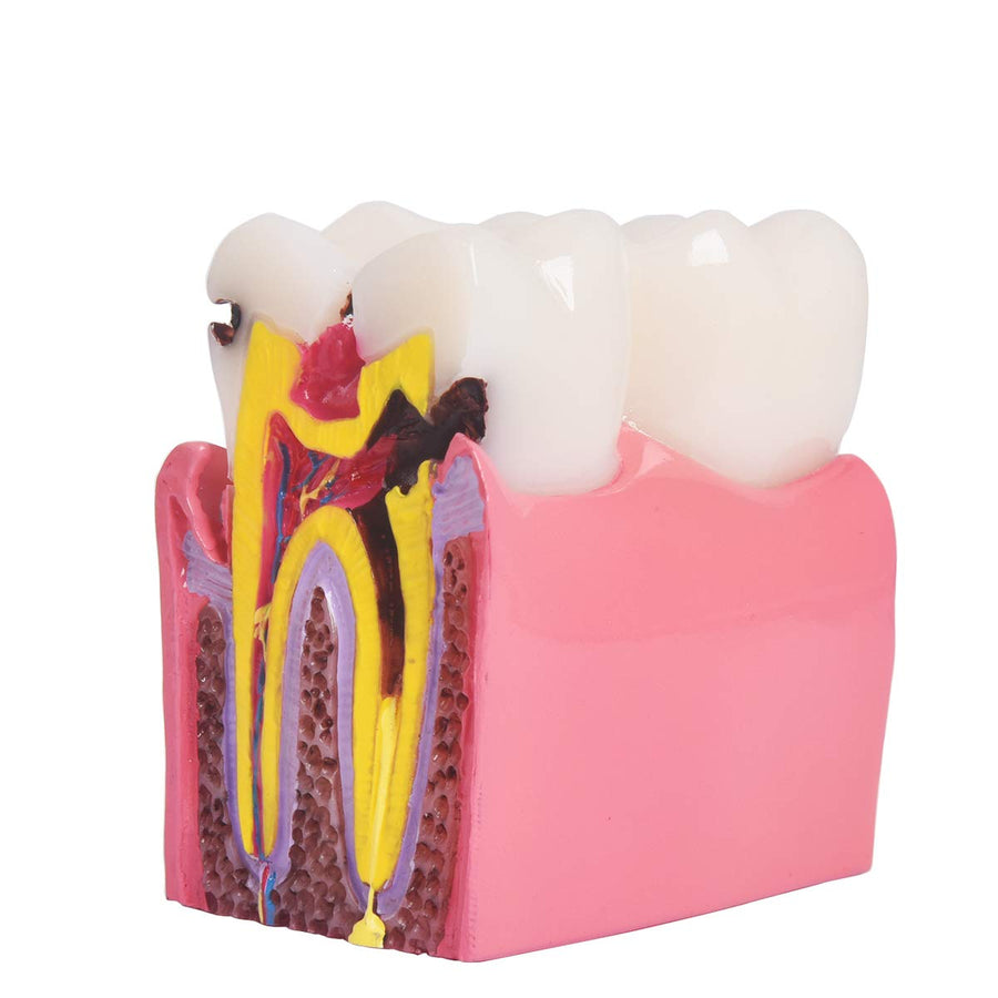 Dental Caries Teeth Model,Dental Anatomy Education Tooth Model,6 Times Caries Teaching Typodont Tool for Dentists, Patients, Teachers and Students