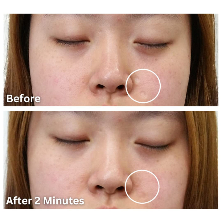 Scar Filler, Refill Applicator