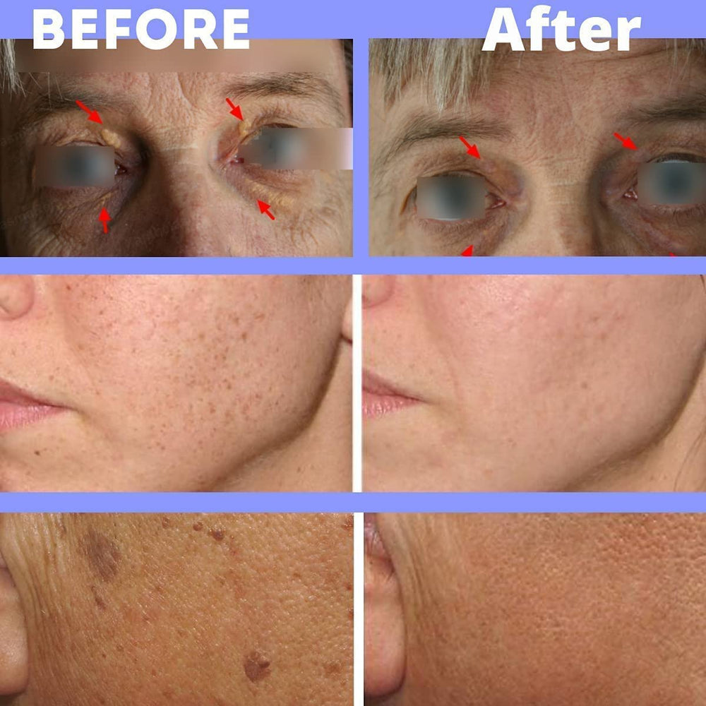 XanthRemover 70% Glycolic Acid Peel Gel Improves The Appearance of Xanthelasma with Kojic Acid, Cosmetic Peel, Exfoliating