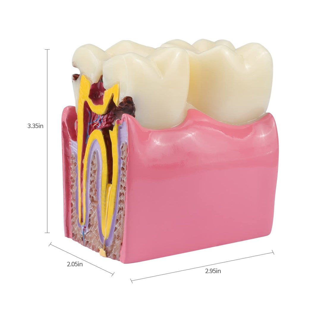 Dental Caries Teeth Model,Dental Anatomy Education Tooth Model,6 Times Caries Teaching Typodont Tool for Dentists, Patients, Teachers and Students