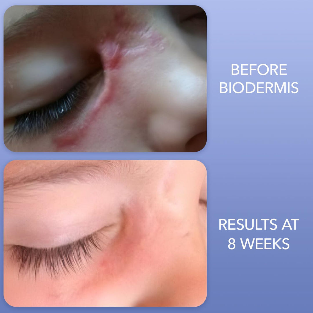 Biodermis Prosil Silicone Scar Stick Keloid And Hypertophic Scar Glide On Powerful Easy To Use Applicator (4.25 g)