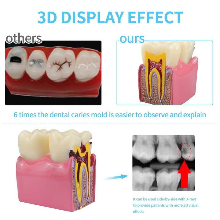 Dental Caries Teeth Model,Dental Anatomy Education Tooth Model,6 Times Caries Teaching Typodont Tool for Dentists, Patients, Teachers and Students