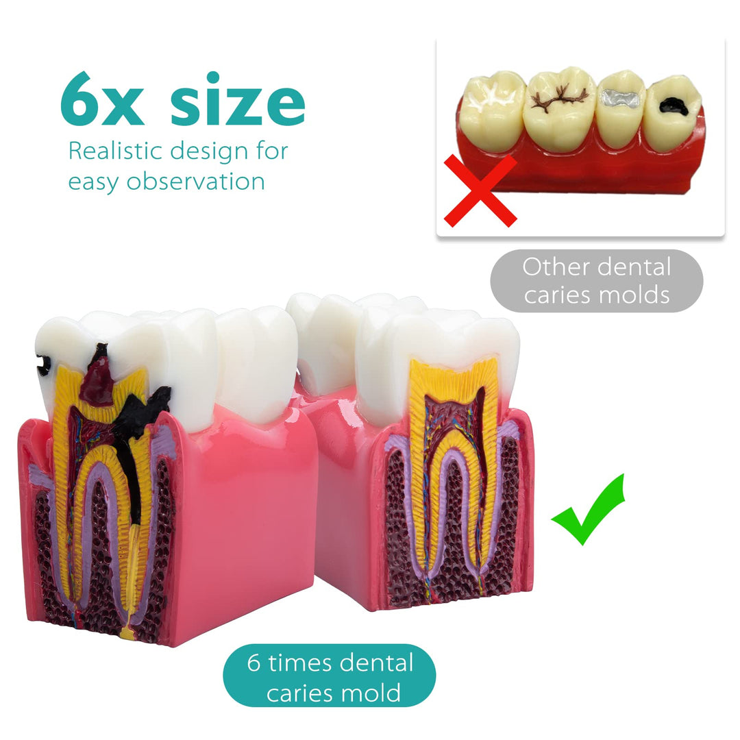 Dental Caries Teeth Model - Anatomy Education Model Caries Bilateral Comparison Study Model 6 Times Cross-Section Demonstration Model Tooth Decay Props for Science Teaching
