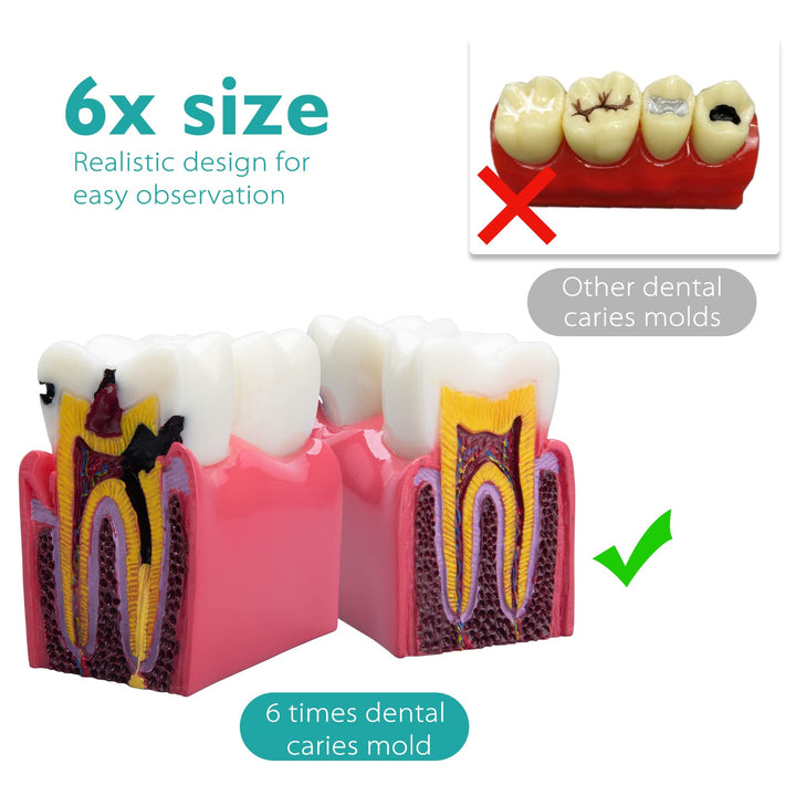 Dental Caries Teeth Model - Anatomy Education Model Caries Bilateral Comparison Study Model 6 Times Cross-Section Demonstration Model Tooth Decay Props for Science Teaching