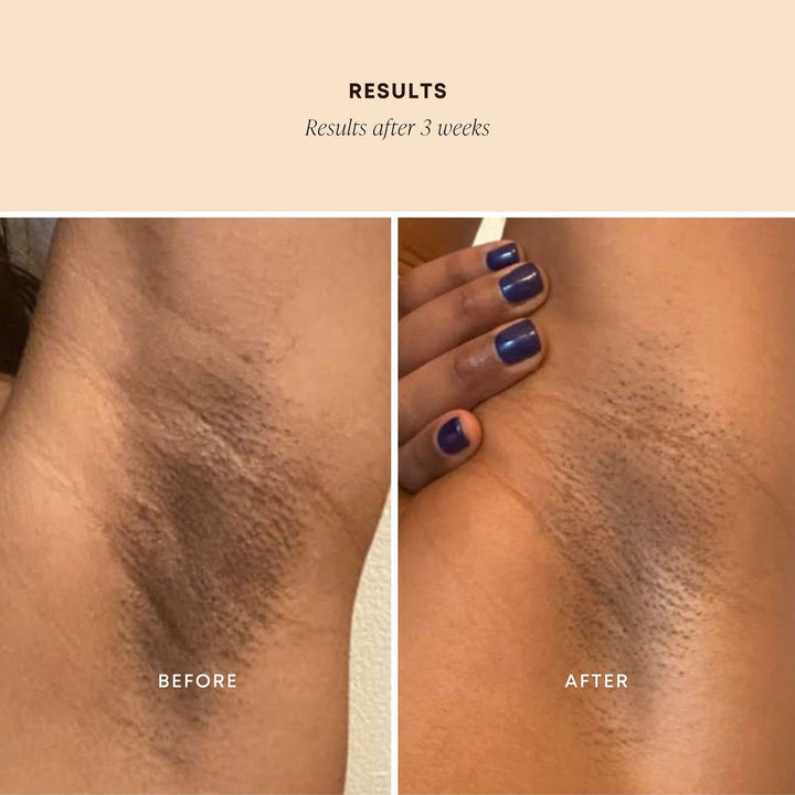 Dark Spot Exfoliating Scrub - Natural Body Scrub Exfoliant to Hydrated, Soften and Enhance Glow in Skin - Bermuda 236 ml