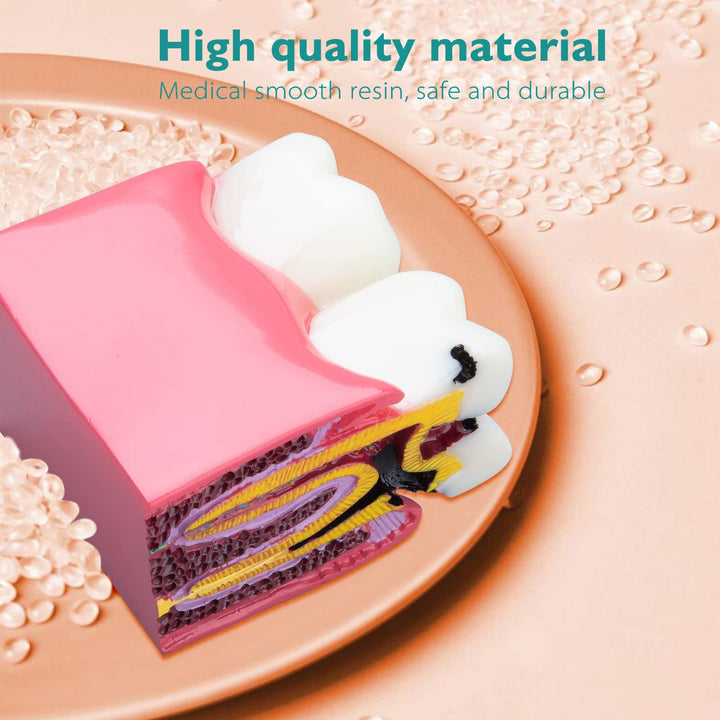 Dental Caries Teeth Model - Anatomy Education Model Caries Bilateral Comparison Study Model 6 Times Cross-Section Demonstration Model Tooth Decay Props for Science Teaching