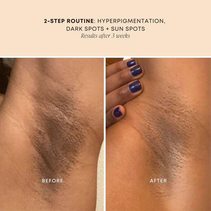 Dark Spot Oil - Improve Appearance of Dark Spots, Ingrown Hair All Over Body, soothe, Rejuvenate and Nourish, Bermuda Oil - 30ml