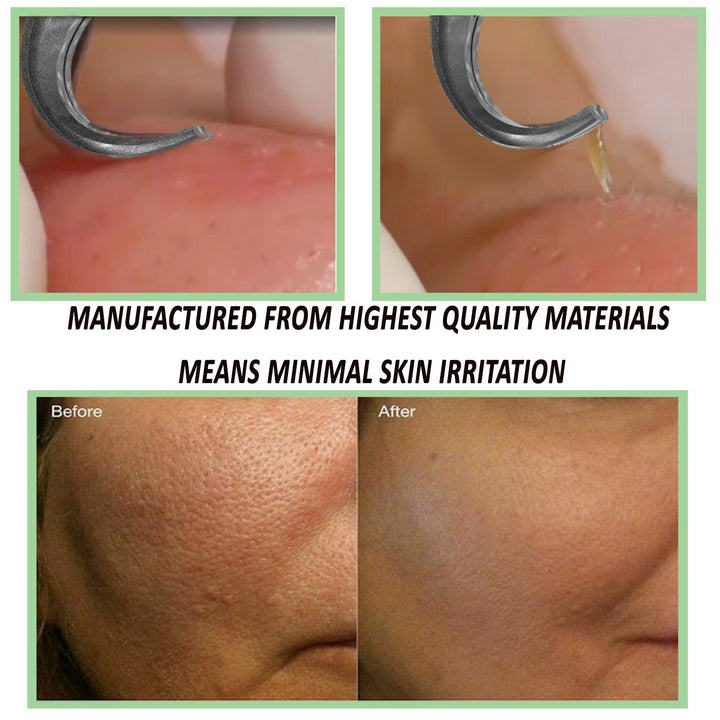 Blackhead Tweezer - Professional Curved Steel Tip Surgical Comedone & Splinter Extractor By . Ideal Blemish & Acne Remover Tool Means Flawless Facial Skin For You Today.