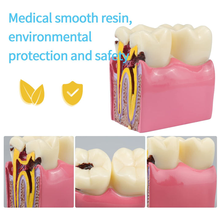 Dental Caries Teeth Model,Dental Anatomy Education Tooth Model,6 Times Caries Teaching Typodont Tool for Dentists, Patients, Teachers and Students