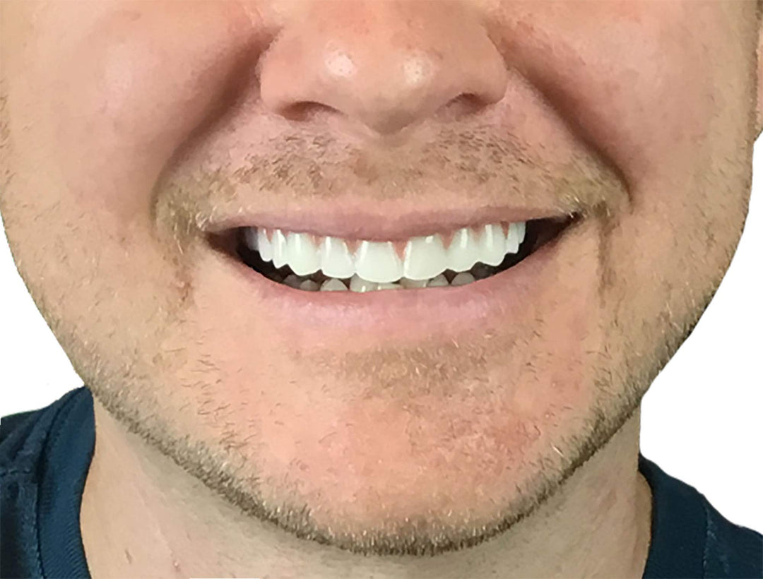 Comfort Fit Flex - Natural Shade - Upper Veneer Cosmetic Teeth