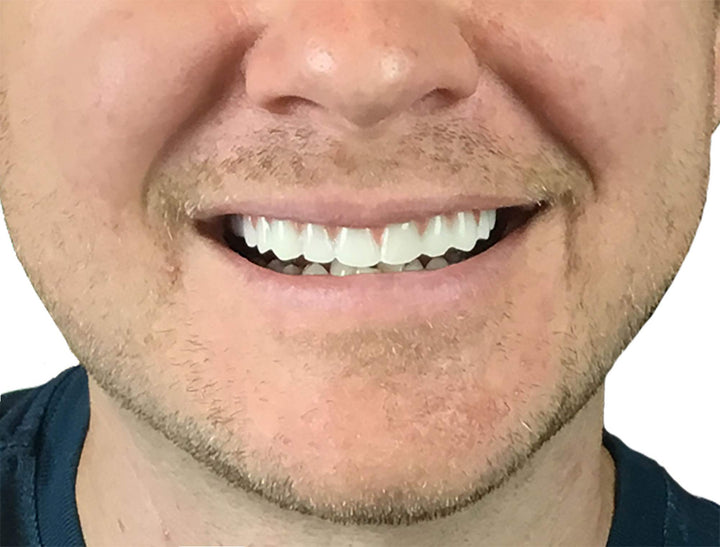 Comfort Fit Flex - Natural Shade - Upper Veneer Cosmetic Teeth