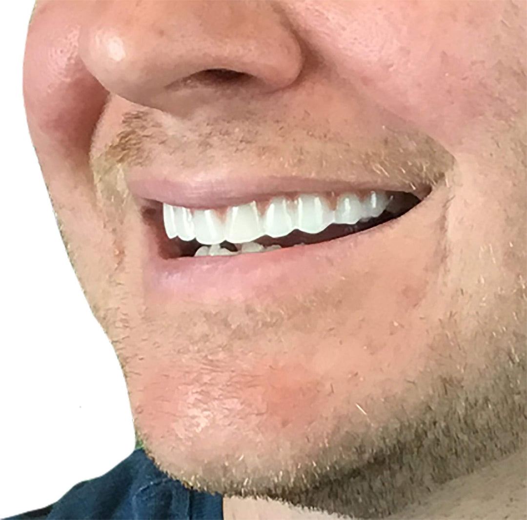Comfort Fit Flex - Natural Shade - Upper Veneer Cosmetic Teeth
