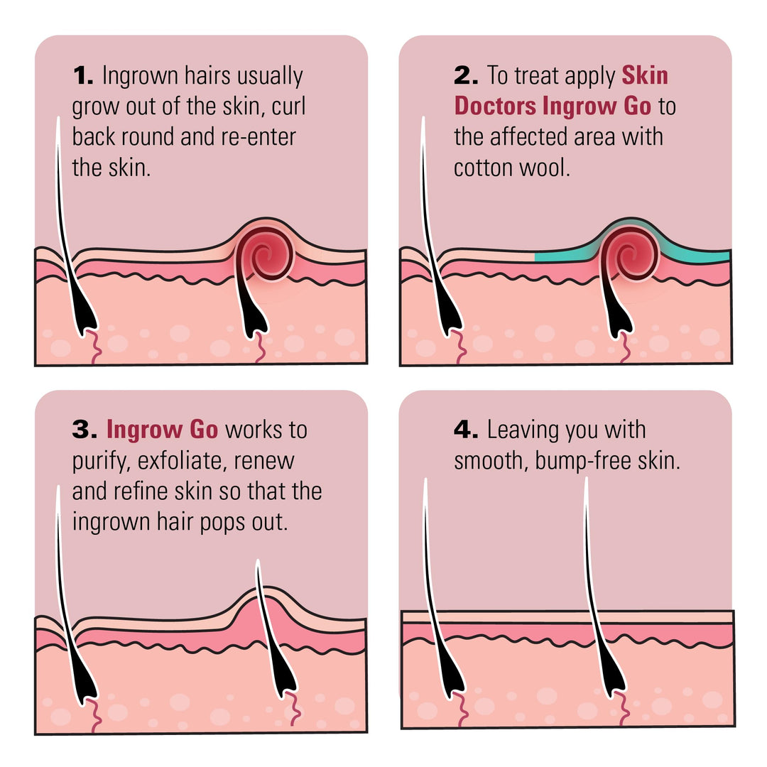 Ingrow Go Ingrown Hair Lotion 120mls