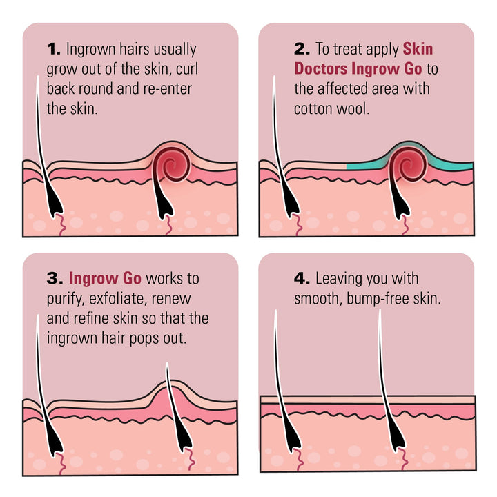 Ingrow Go Ingrown Hair Lotion 120mls