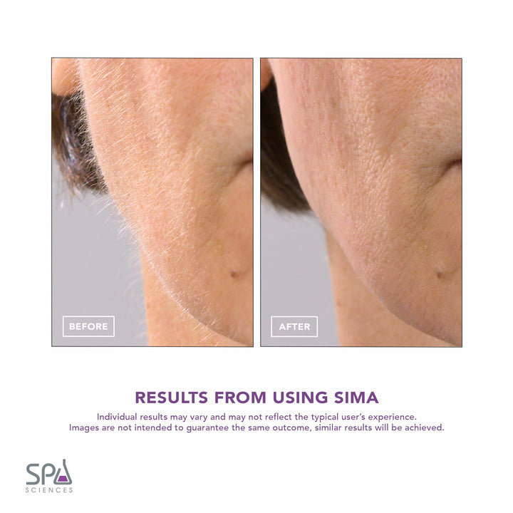 - SIMA Sonic Dermaplaning Tool - Patented Painless 2 in 1 Facial Exfoliation & Peach Fuzz-Hair Removal System w/ 7 Weeks Treatment Included - Anti-Aging – 3 Speeds – Rechargeable