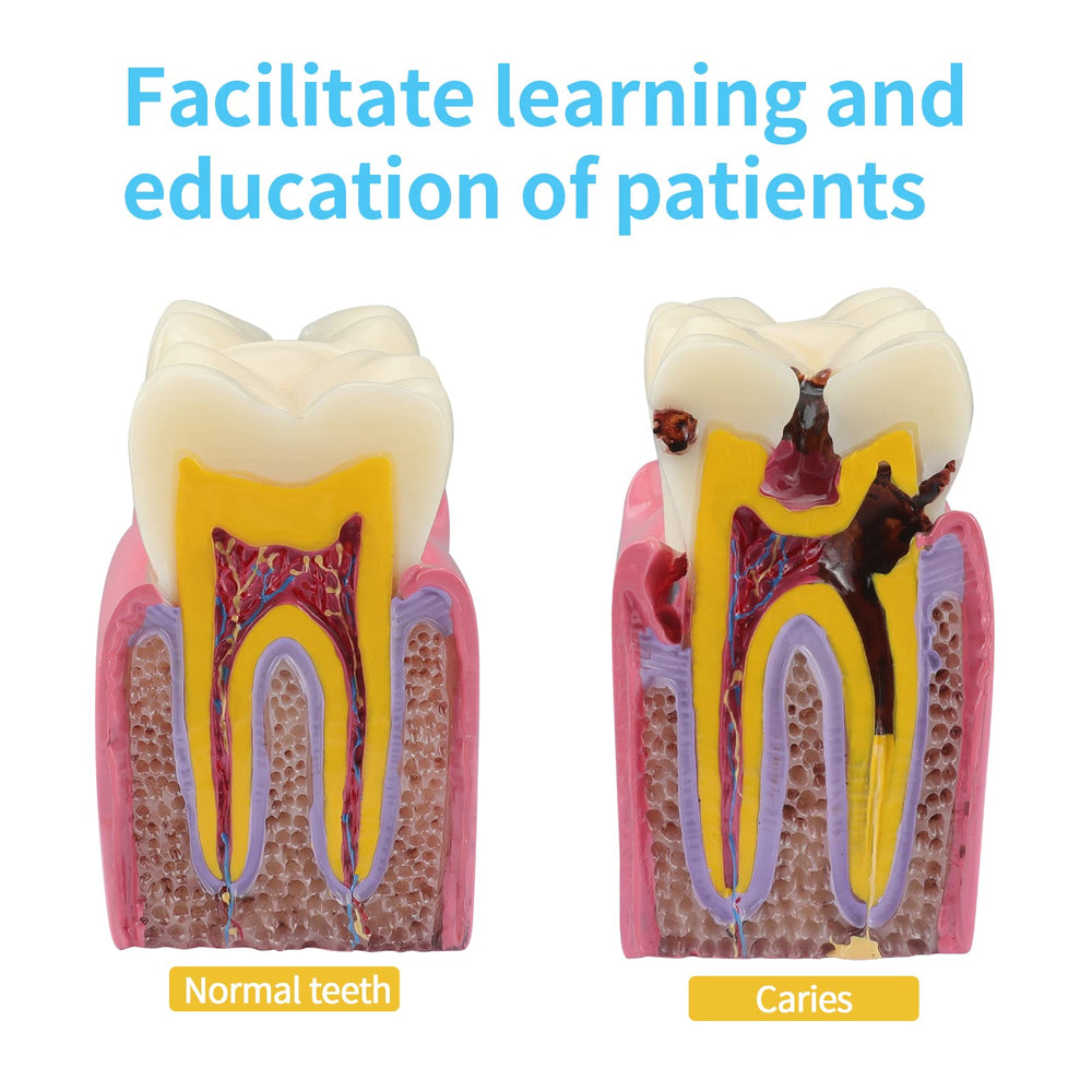 Dental Caries Teeth Model,Dental Anatomy Education Tooth Model,6 Times Caries Teaching Typodont Tool for Dentists, Patients, Teachers and Students