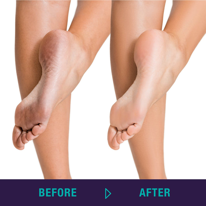 Simply Foot 4-in-1 Foot Paddle – Include Metal Foot Rasp, Pumice Stone, Foot Brush, and Abrasive Surface – Easy to Use Foot Care Tools for DIY Pedicures – Ideal for Men and Women