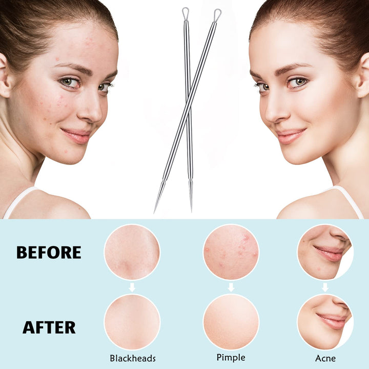 Titanium Lancet Needle Pimple Popper Tool Facial Milia Remover Blackhead Blemish Remover Blackhead Whitehead Extractor Professional Lancet Zit Blemish Comedone Removal Tool 2 Pieces with Box