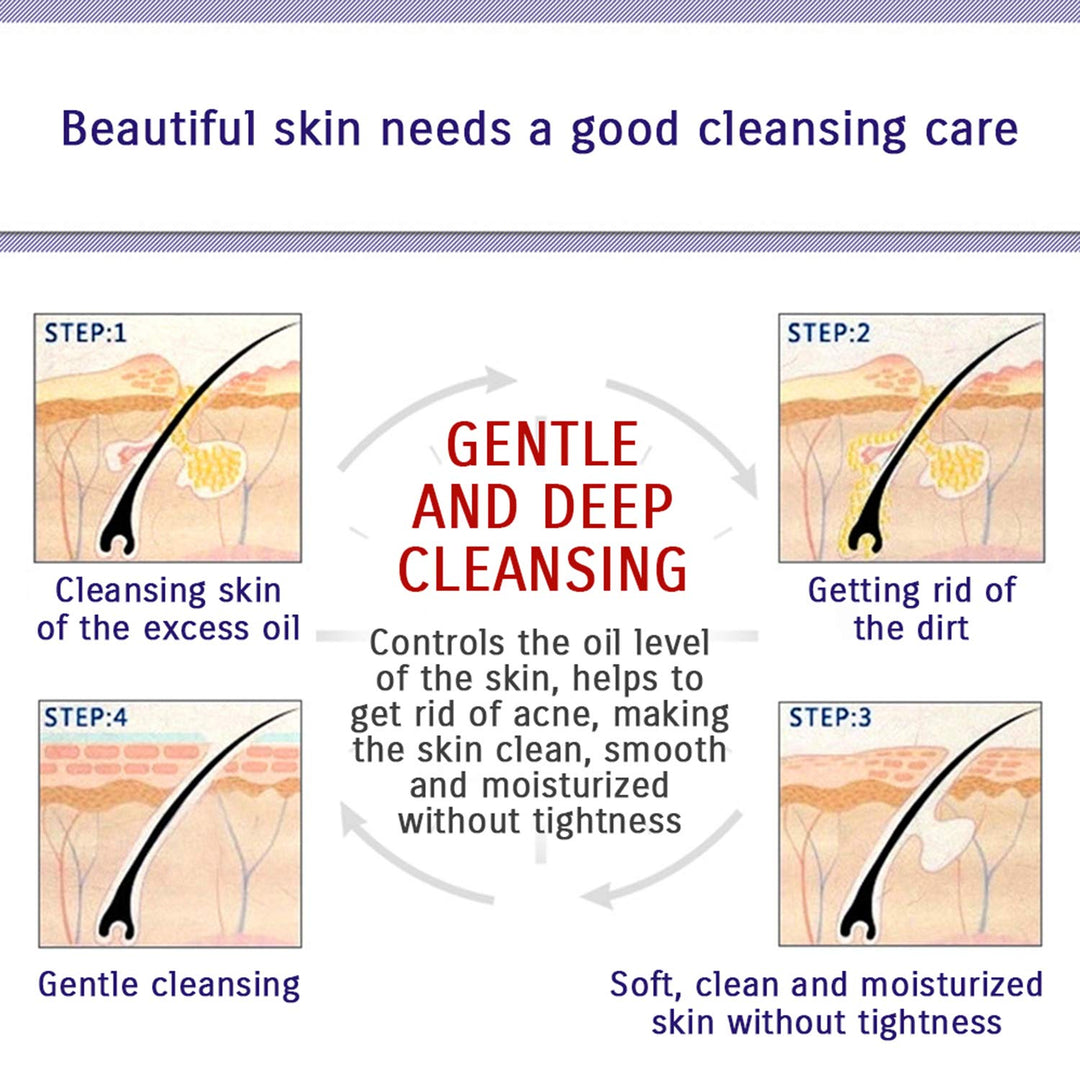 Skin Care Acne Face Treatment Removal Cream Spots Scar Blemish Mark 100g