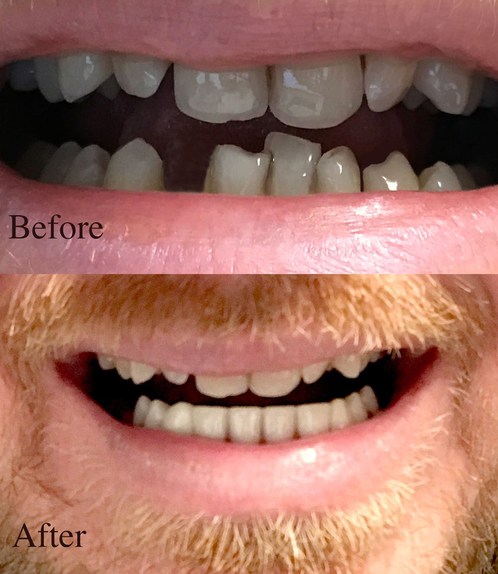 Professional Cosmetic Lower Teeth - New from Hand crafted detail, custom fit at home!