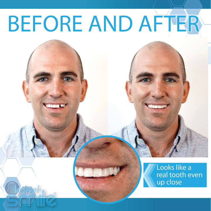 Complete Your Smile Temporary Tooth Replacement Kit - Replace a Missing Tooth in Minutes - Patented