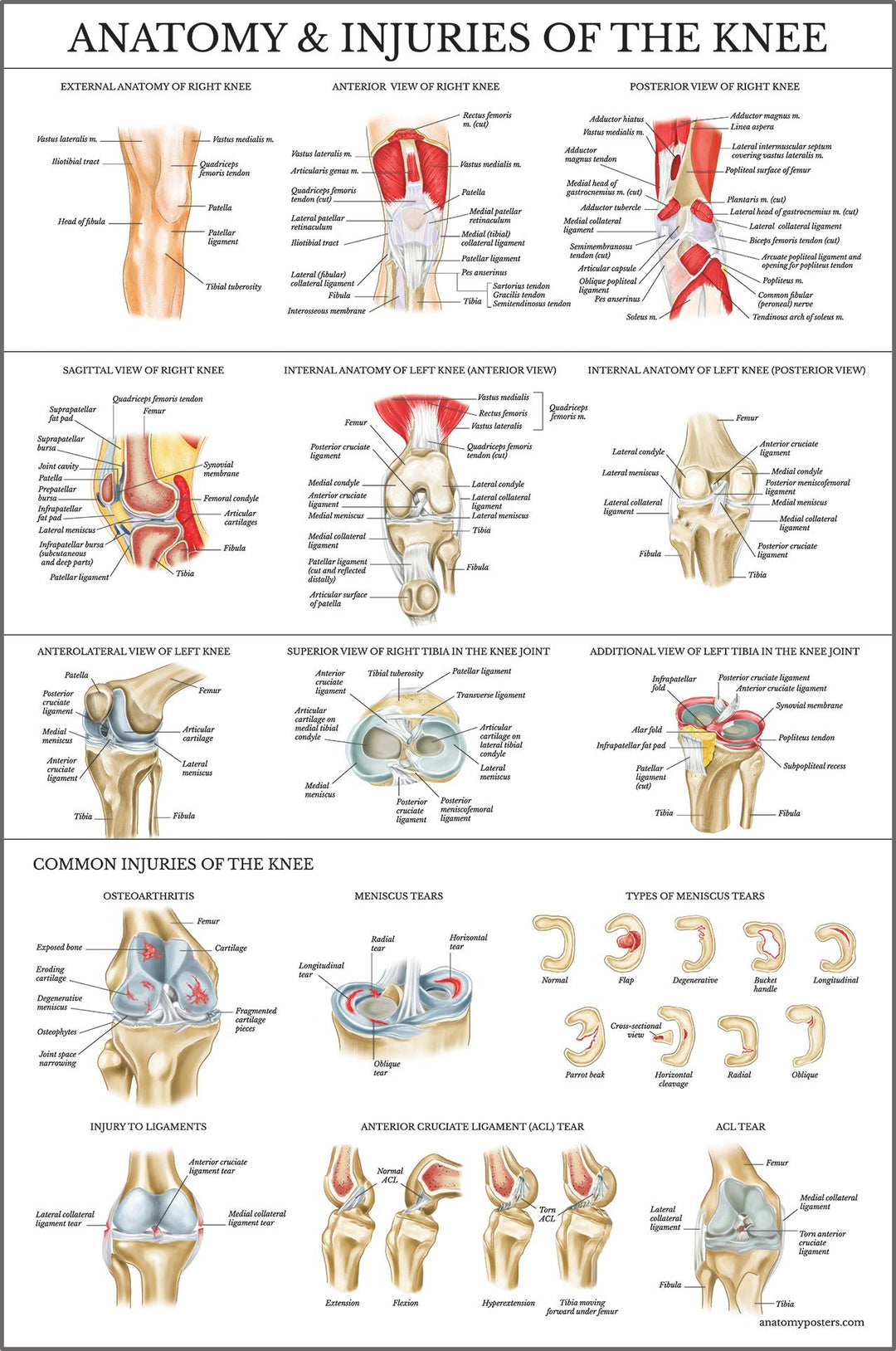 Laminated Anatomy and Injuries of the Knee Poster - Knee Joint Anatomical Chart - 18 x 24