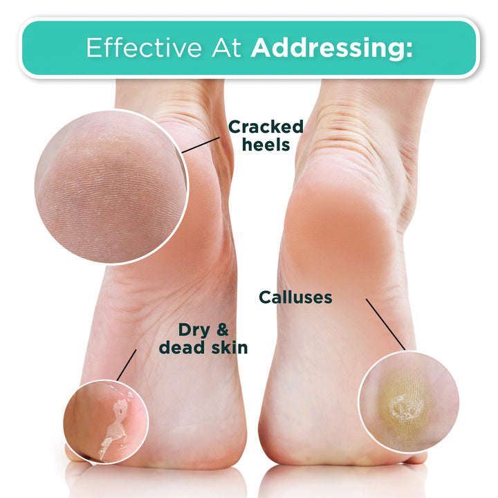 Foot Peel Mask - 2 Pack of Regular Size Skin Exfoliating Foot Masks for Dry, Cracked Feet, Callus, Dead Skin Remover - Feet Peeling Mask for baby soft feet, Tea Tree Scent
