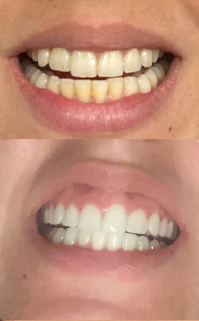 Dr Song Teeth Whitening Kit 3X Syringes 35% Carbamide P