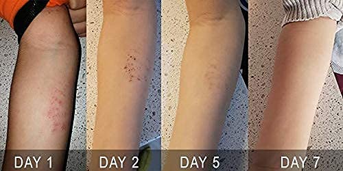 Orellis Eczema Relief Cream For Body &amp; Face. Po