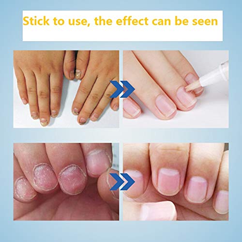 4 Pcs Nail Repair Treatment for Toenail and Fingernail,Toenail Nail Treatment,Nail Repair Pen Renew Damaged Discolored Foot &amp; Toenails