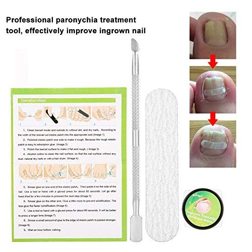 Professional Ingrown Pincer Toenail Correction Sticker Pedicure Paronychia Recover Foot CareTool with Nail File and Cuticle Pusher(12Pcs Patches)