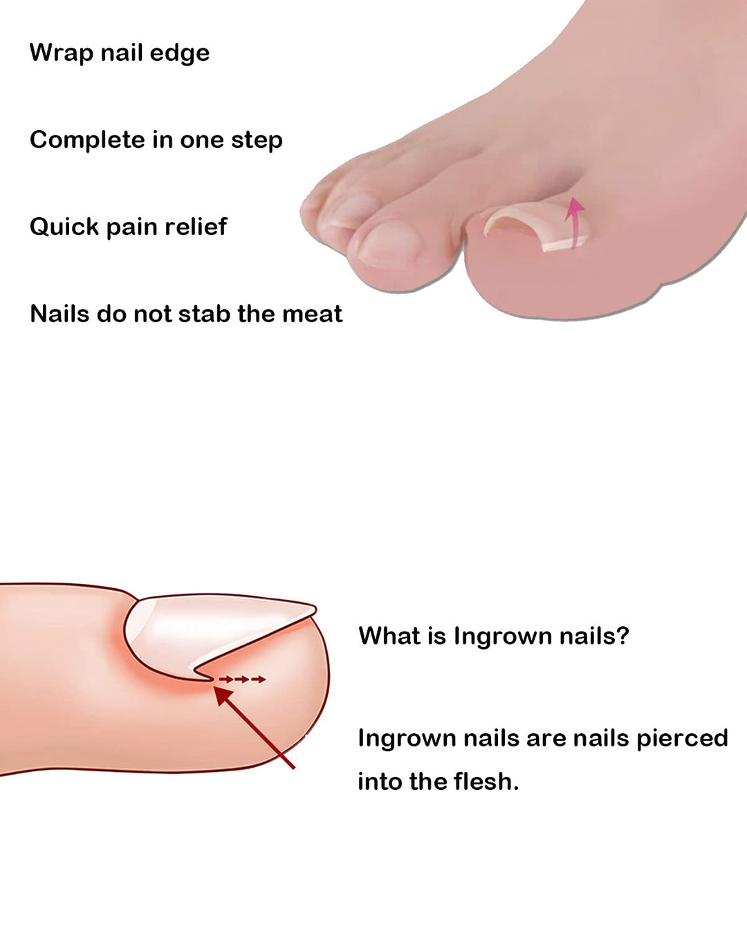 (50 +2) Pack Professional Ingrown Toenail Correction Treatment Kit, 50 Pcs Ingrown Toenail Corrector Straightener Strips Recover Clips with 2 Pcs Ingrown Toenail File And Lifter