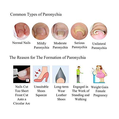 Professional Ingrown Pincer Toenail Correction Sticker Pedicure Paronychia Recover Foot CareTool with Nail File and Cuticle Pusher(12Pcs Patches)