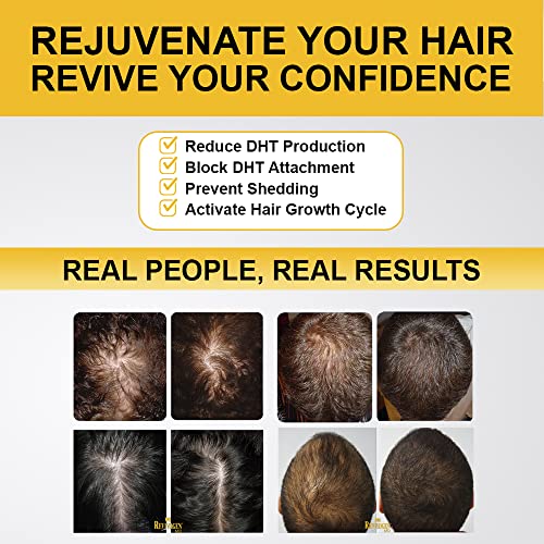 MD Scalp Therapy 3 Month Kit Thinning Hair Solution, Natural DHT Blocker Ingredients, Experience Healthier Hair Growth for Men &amp; Women with Hair Loss, 2 Fl oz, Pack of 3