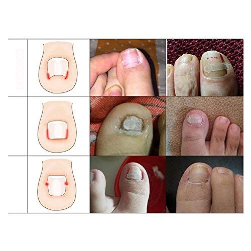 Professional Ingrown Pincer Toenail Correction Sticker Pedicure Paronychia Recover Foot CareTool with Nail File and Cuticle Pusher(12Pcs Patches)