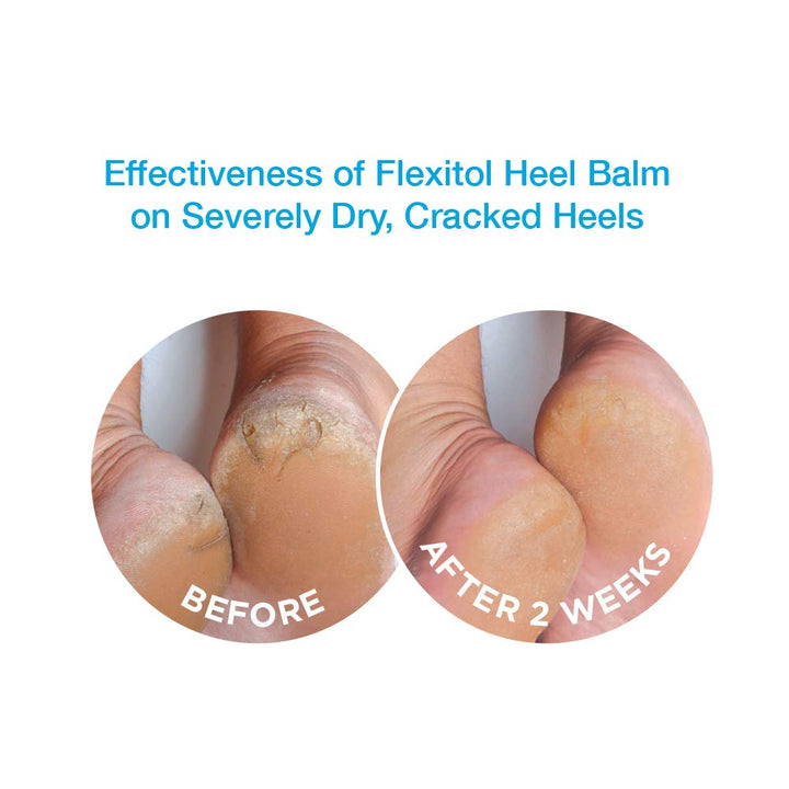 Flexitol Heel Balm 4 Oz Tube (Pack of 2), Rich Moisturi